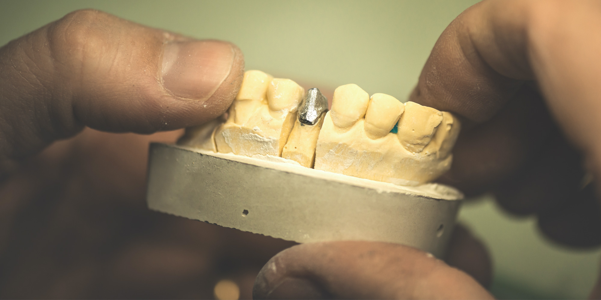 Precious Alloy – Porclain Fused to Mental